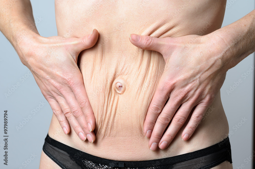 Woman displaying stretch marks after pregnancy Woman displaying stretch marks after pregnancy