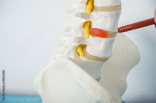 Doctor with a pen showing a hernia in a sckeleton.