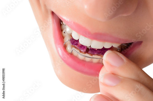 Woman wearing orthodontic removable braces