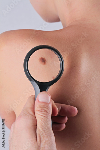 Close up of doctor dermatologist examines a birthmark of patient. Checking benign moles