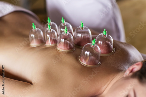 Woman with cupping treatment on back photo