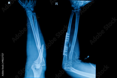 Collection of human x-rays  showing fracture  of radius  bone , photo