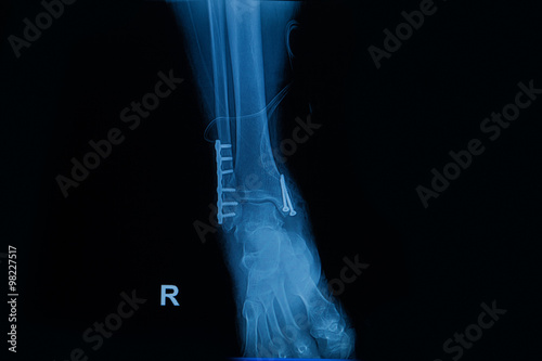 human x-rays  showing fracture of right leg ( fracture both bones )