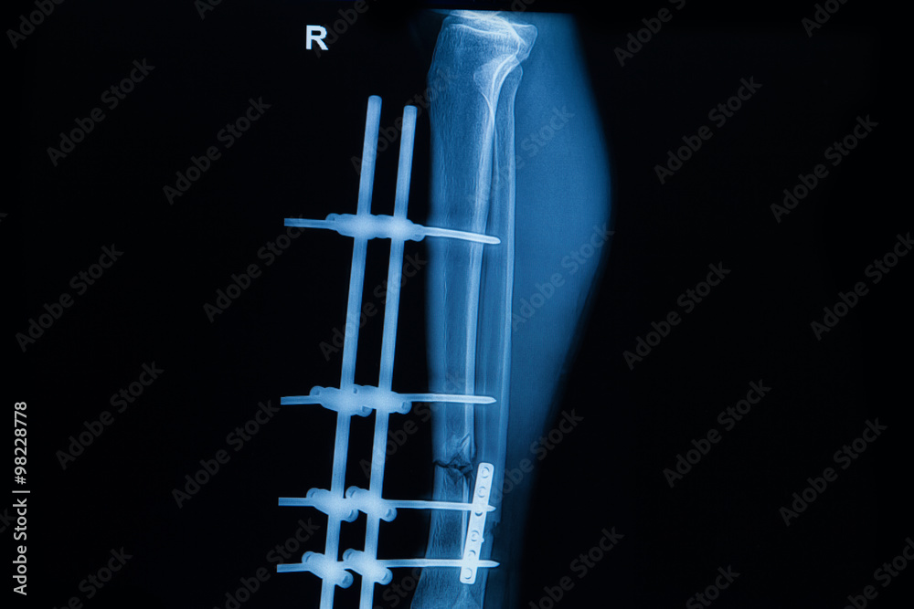 Post Roket Leg human x-rays , fracture of right leg post operated with external ...