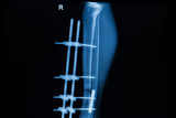  human x-rays , fracture of right leg post operated with external fixation 