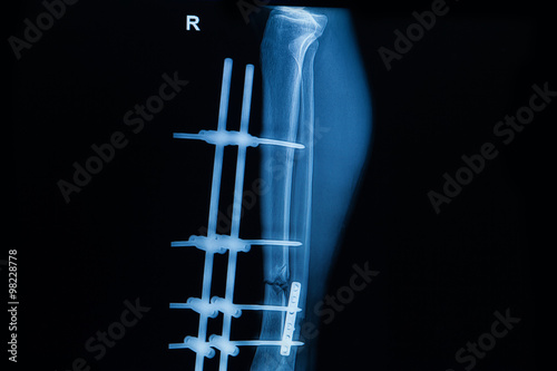  human x-rays   fracture of right leg post operated with external fixation 