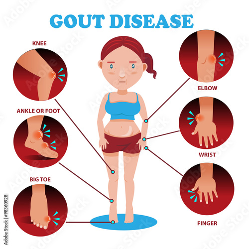Painful and inflamed gout on her body around the Bones and joints in the circle.