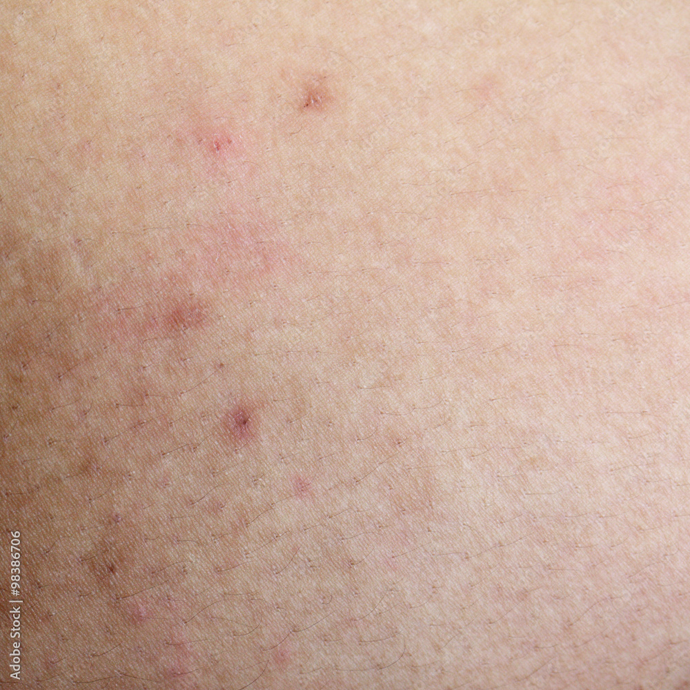 Fototapeta premium Scar on human skin