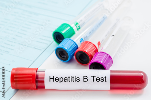 Blood sample for hepatitis B virus (HBV) testing. photo