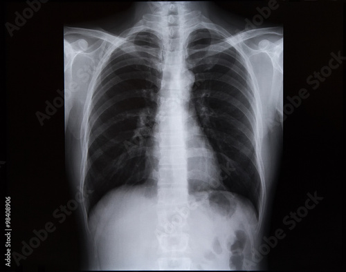 X-rays of the spine and chest. Medicine