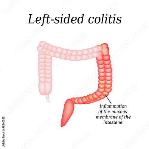 Inflammation of the large intestine divisions. Vector illustration on isolated background photo