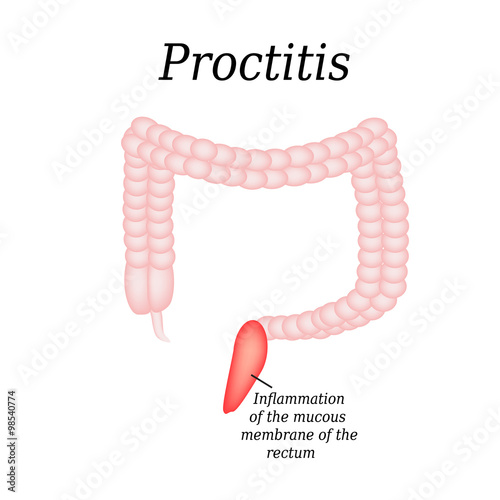 Colon. Proctitis. Vector illustration on isolated background photo