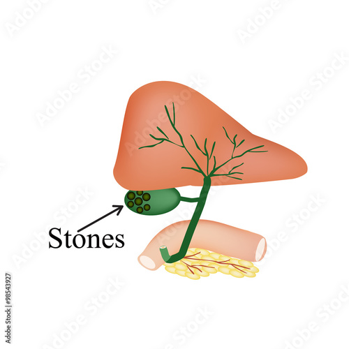 The stones in the gallbladder. Duodenum, pancreas, bile ducts. Vector illustration on isolated background