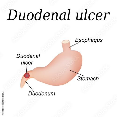 Duodenum ulcer affected. Duodenal ulcer. Vector illustration on a background of isolation