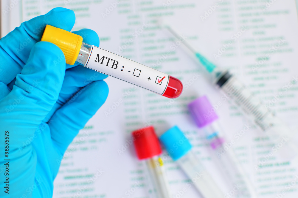 Naklejka premium MTB positive blood sample