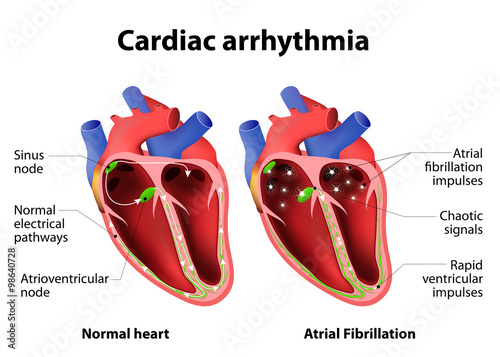 Cardiac arrhythmia photo