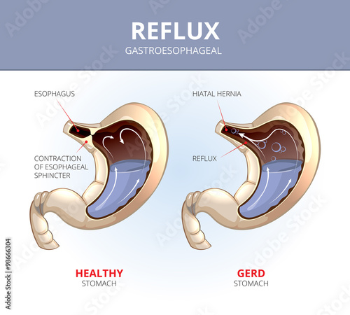 Gastroesophageal reflux disease. Healthy and sick stomach. Vector medical GERD infographic photo