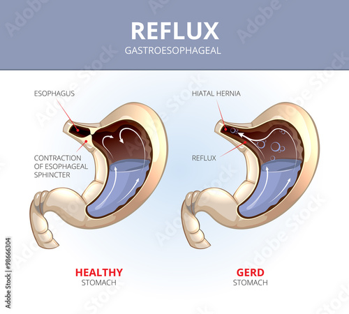 Gastroesophageal reflux disease. Healthy and sick stomach. Vector medical GERD infographic