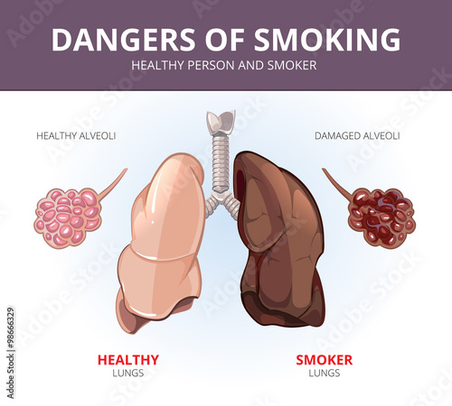 Lungs and alveoli of a healthy person smoker. Vector medical diagram