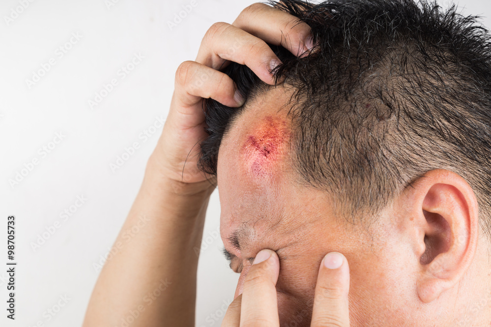 Selective focus on painful red swollen forehead injury Selective focus on painful red swollen forehead injury
