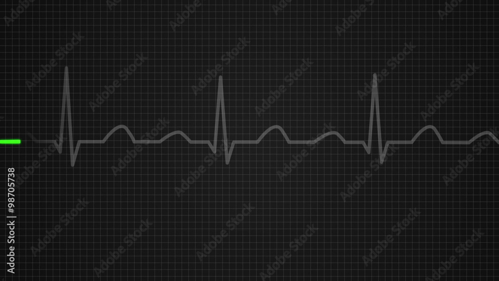 Animation of a diagram showing values for a death on electrocardiograph screen Animation of a diagram showing values for a death on electrocardiograph screen