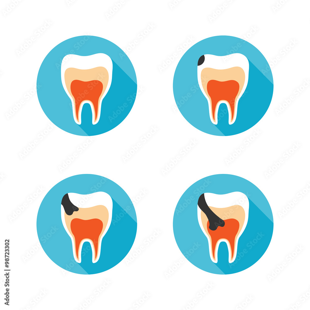 Set icons with flat design elements of tooth decay disease. Stages of tooth decay on white background. Modern vector pictogram collection concept - stock vector Set icons with flat design elements of tooth decay disease. Stages of tooth decay on white background. Modern vector pictogram collection concept - stock vector