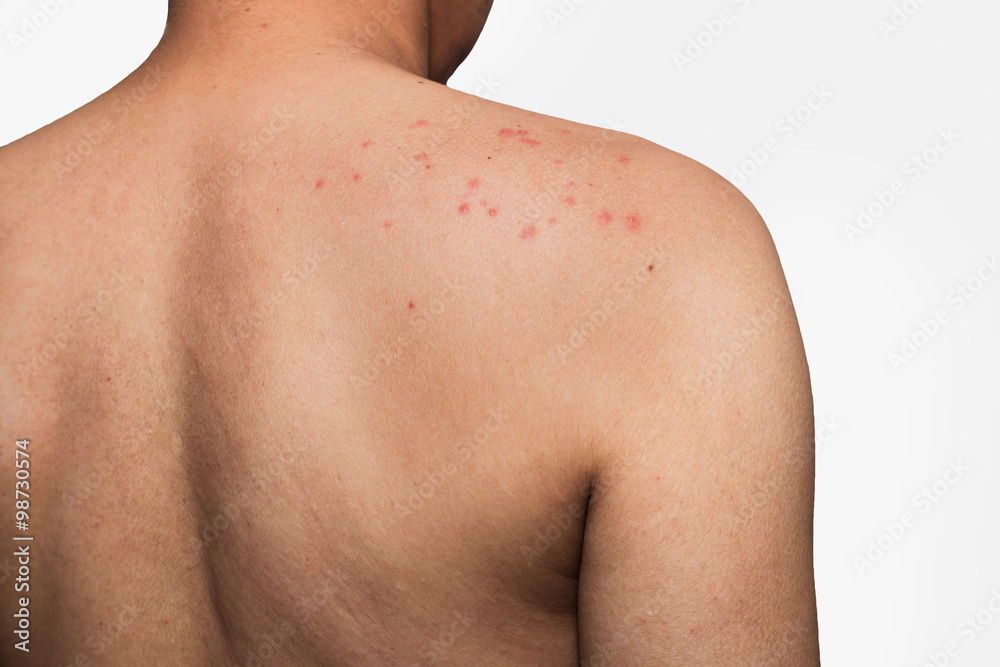 Naklejka premium man with dermatitis problem of rash