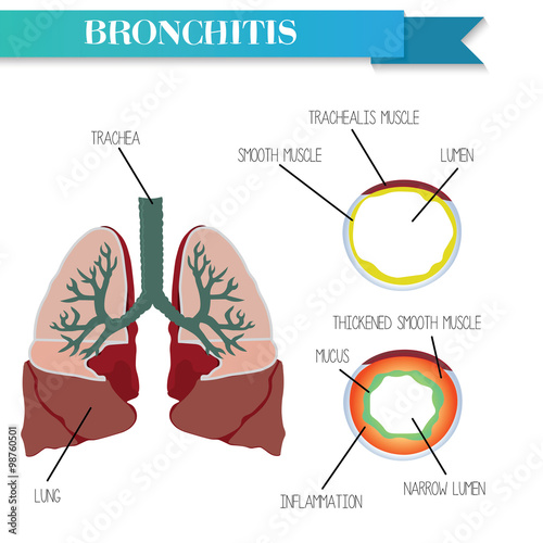 Healthy and inflamed bronchus. Chronic Bronchitis.