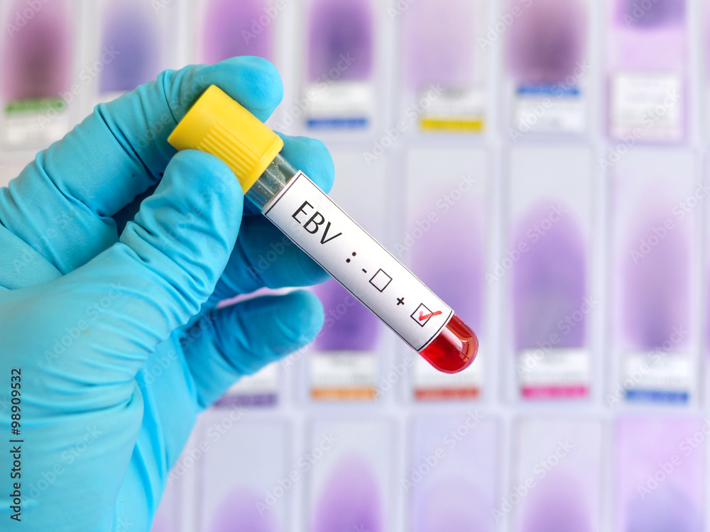 Fototapeta premium Epstein-Barr virus (EBV) positive