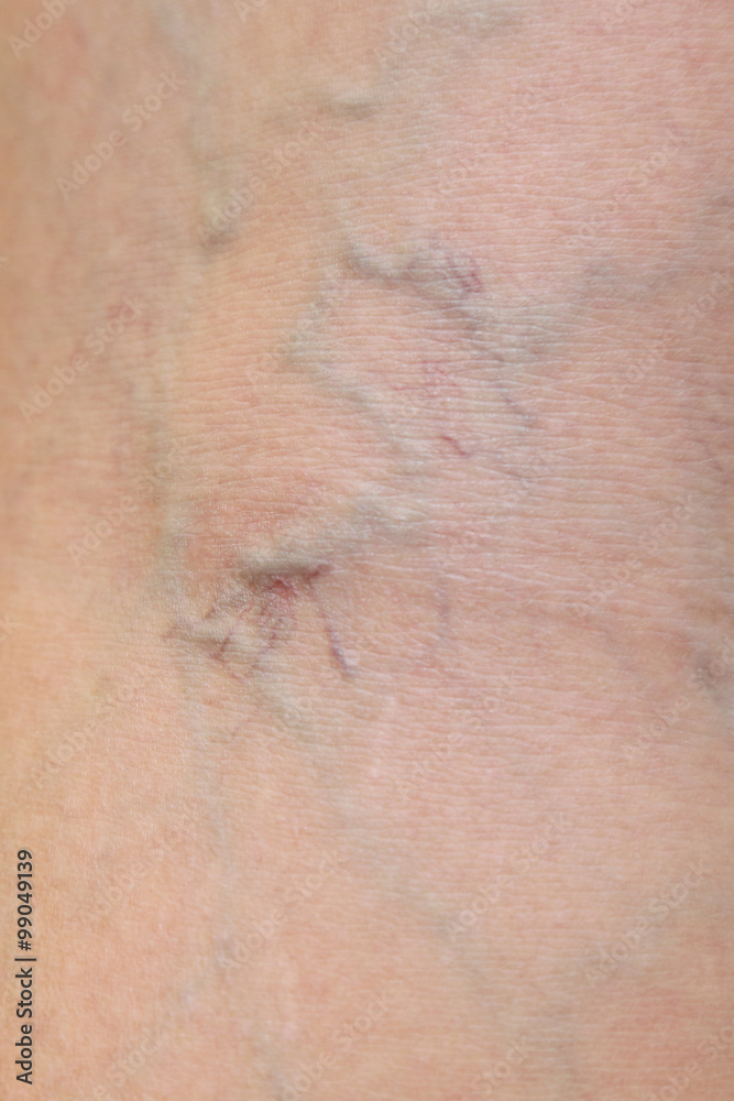 Fototapeta premium close-up on varicose veins on the skin