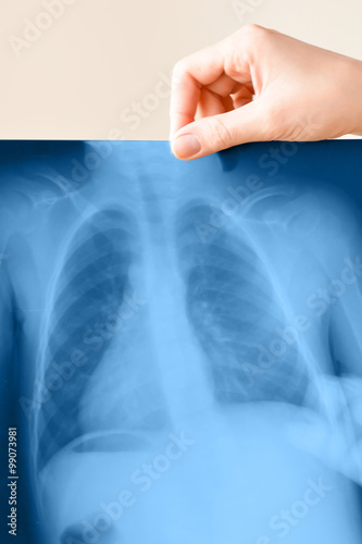 Doctor check a lung x-ray