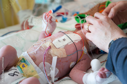 Intensive care after heart surgery, infant child and caring hands helping.
