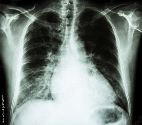 Heart failure ( film x-ray chest PA upright : show cardiomegaly and interstitial infiltrate both lung )