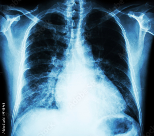 Heart failure  ( film x-ray chest PA upright : show cardiomegaly and interstitial infiltrate both lung )