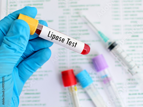 Blood sample for lipase enzyme test, pancreatitis diagnosis