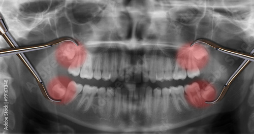 Obraz na płótnie display four wisdom teeth over x-ray