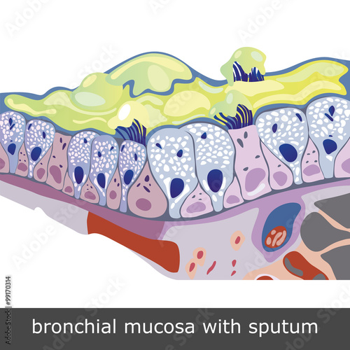 Bronchial Mucosa with Sputum