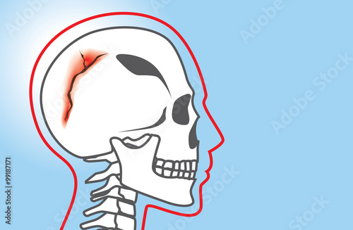 Human have any break in the cranial bone which called skull fracture. This is medical illustration.