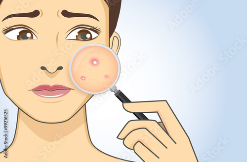 A magnifier on hand magnifying the woman facial to finding acne on her face area. She have feeling stress because acne.