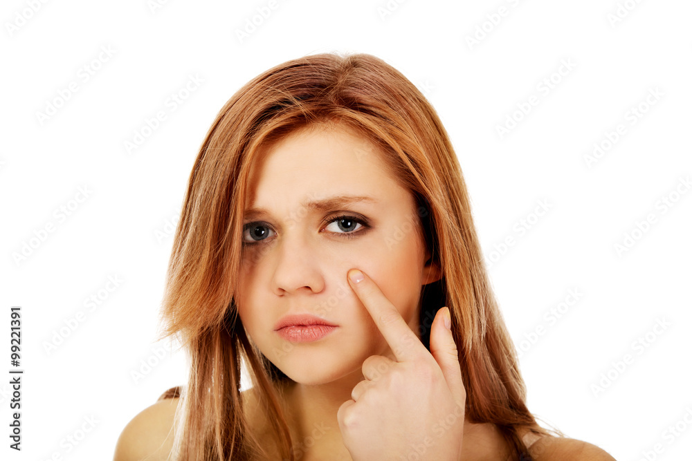 Teenage woman pointing on pimple on her cheek Teenage woman pointing on pimple on her cheek
