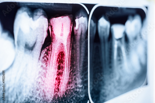 Pain Of Tooth Decay On Teeth X-Ray photo