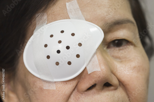 Eye shield covering after cataract surgery.