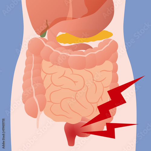 inflammation of the intestine and human digestive organs, vector illustration