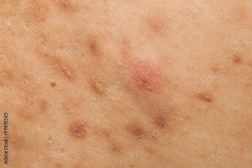 Boy with problematic skin and acne scars in the back
