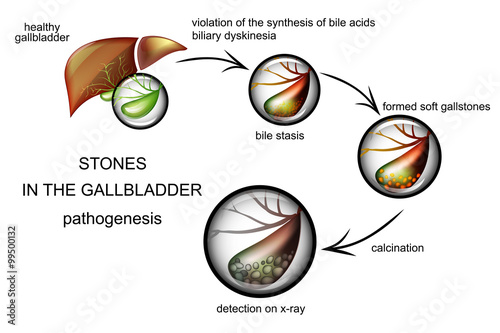 the pathogenesis of gallstones photo
