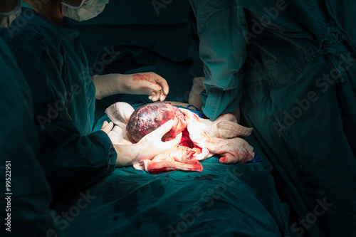 cesarean