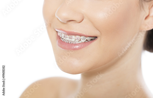 Beautiful young woman wearing braces