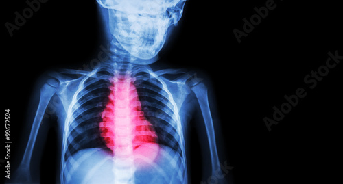 Ischemic Heart Disease , Myocardial Infarction ( MI ) ( Film x-ray body of human with heart disease and blank area at right side ) ( Cardiopulmonary resuscitate and Cardiovascular concept )