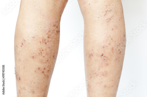 Eczema rash wound on kid's calf