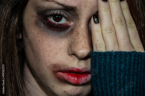 Konstfotografi Closeup of a Young girl that is hiding her face with bruises,after violence - vi